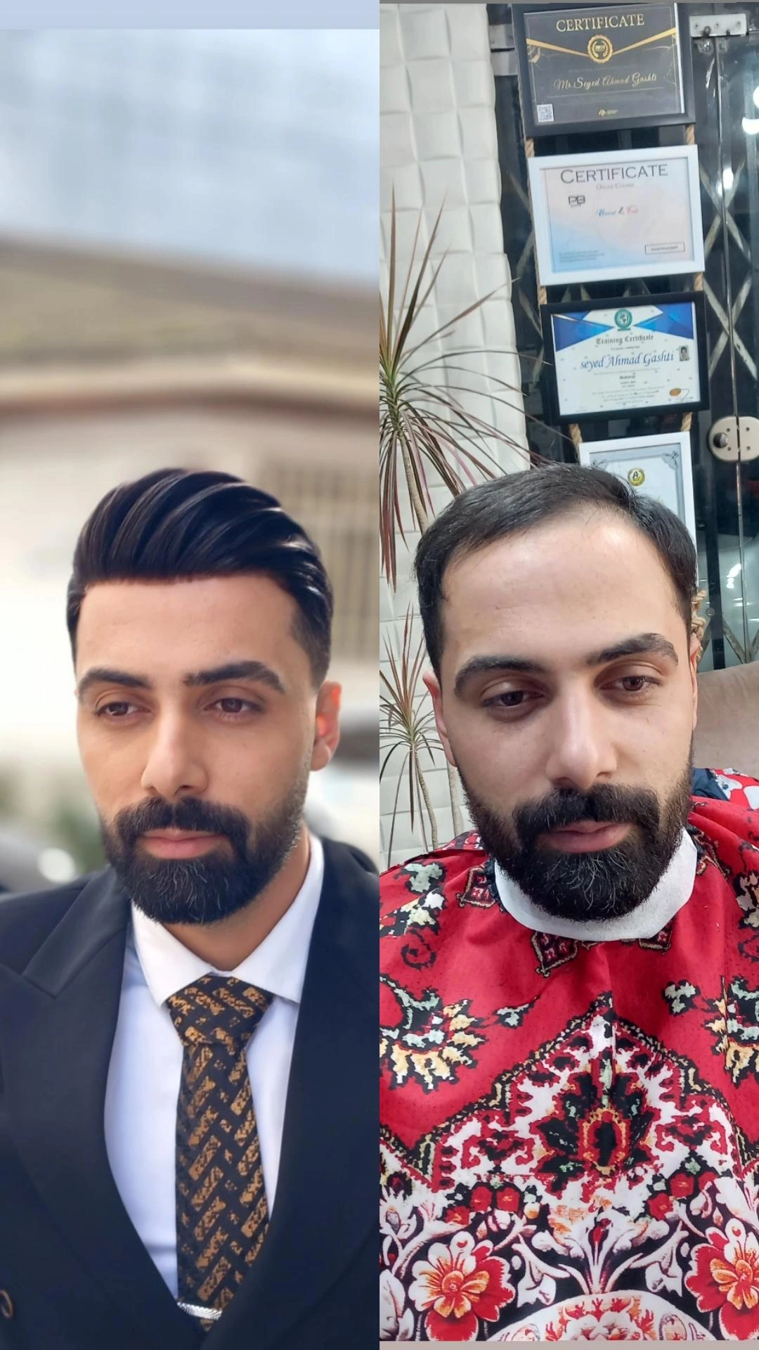 پروتز مو :روش فوری برای درمان کچلی و کم پشتی مو