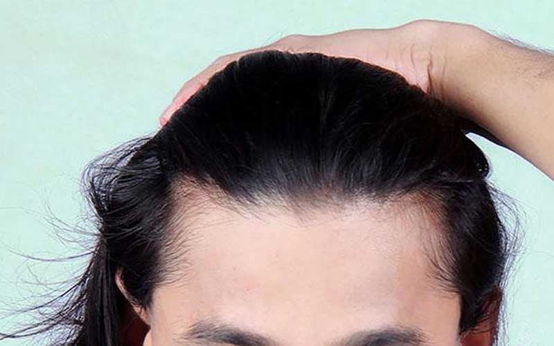 قیمت پروتز مو